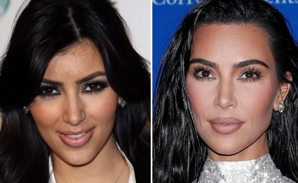 Kim Kardashian Surgery: Reality Star Claims She's Only Had Botox