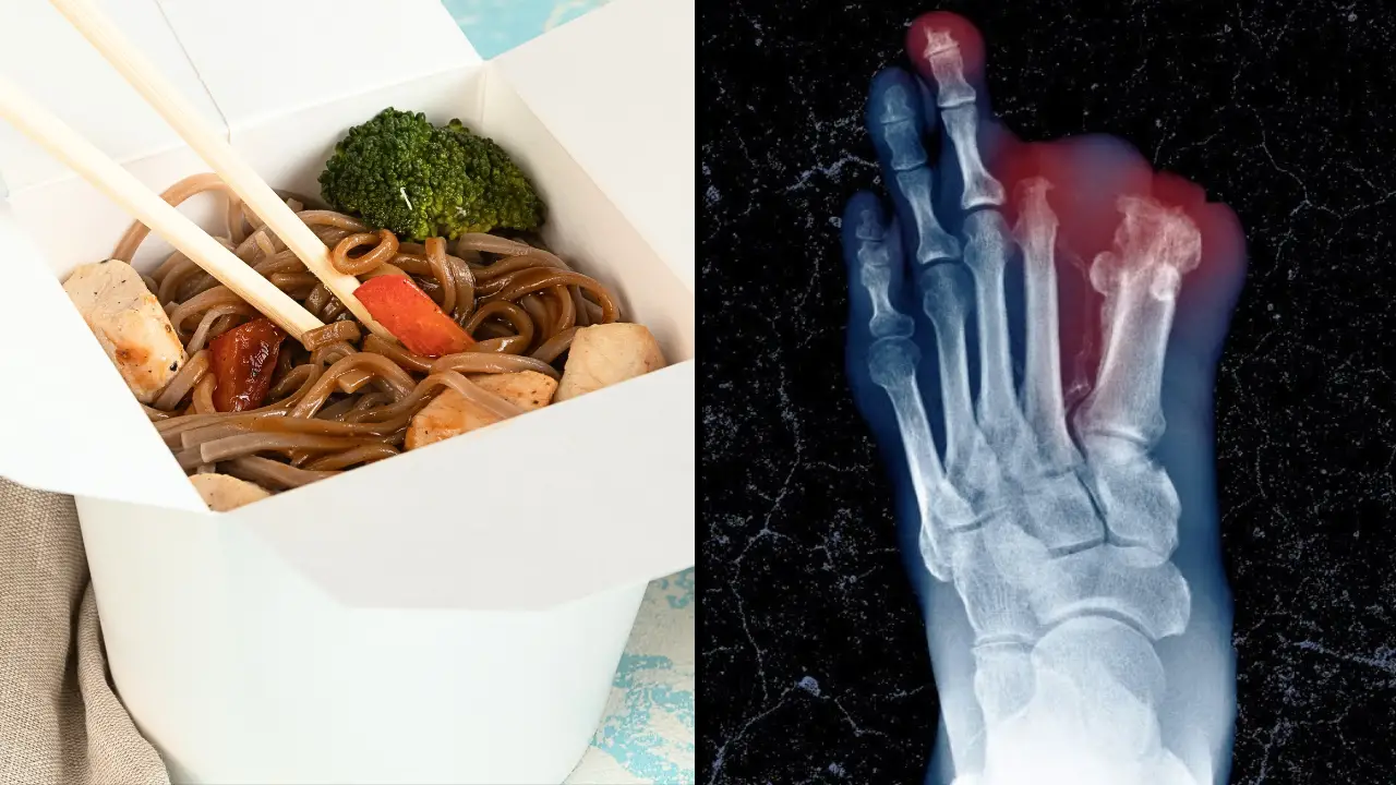 A healthy young man's limbs were amputated after he ate his roommate's leftover noodles.
