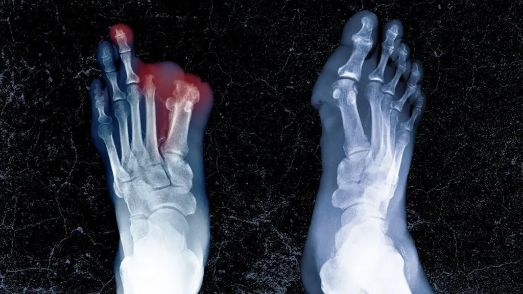 Student's amputated limbs.