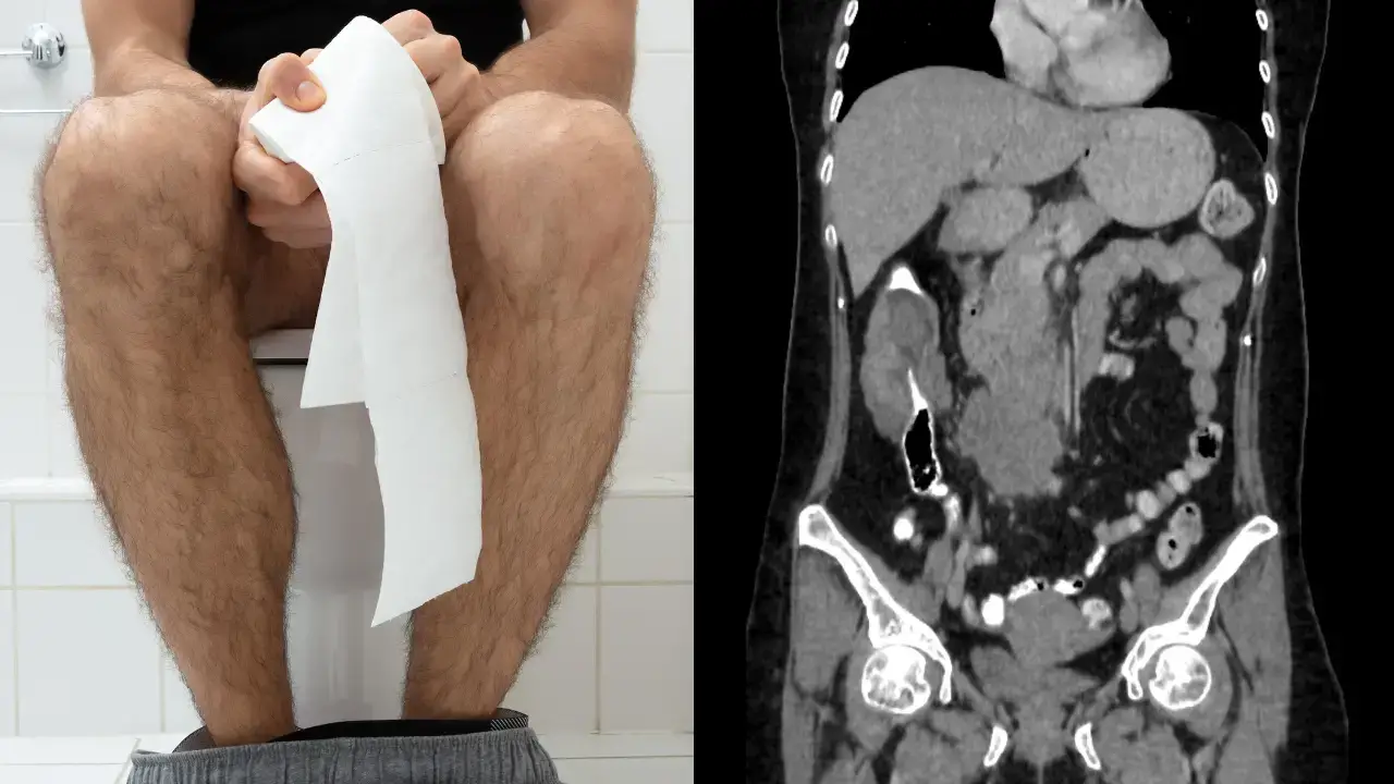 A man lost the feeling in his legs and almost died after being unable to pass a colossal poo. 