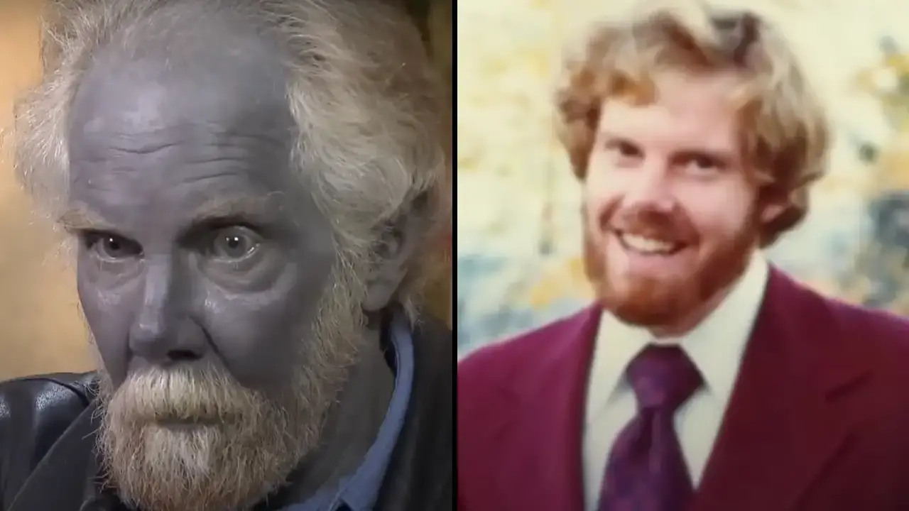 A man turned completely blue after taking a dietary supplement for years.