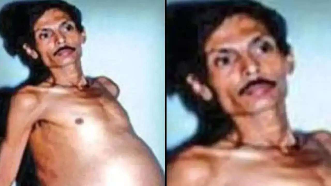 Sanju Bhagat, from India, lived with his twin inside him for 36 years without knowing.