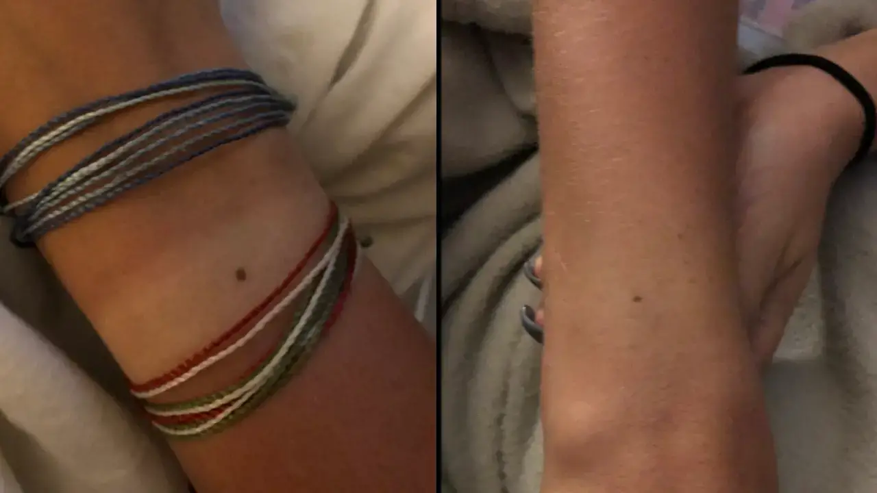 Have you ever noticed a little freckle on your wrist? Well, guess what? You're not alone.