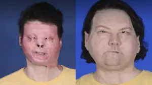 Joe DiMeo before and after face transplant. 