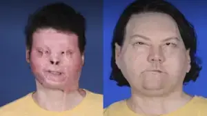 Joe DiMeo before and after face transplant.