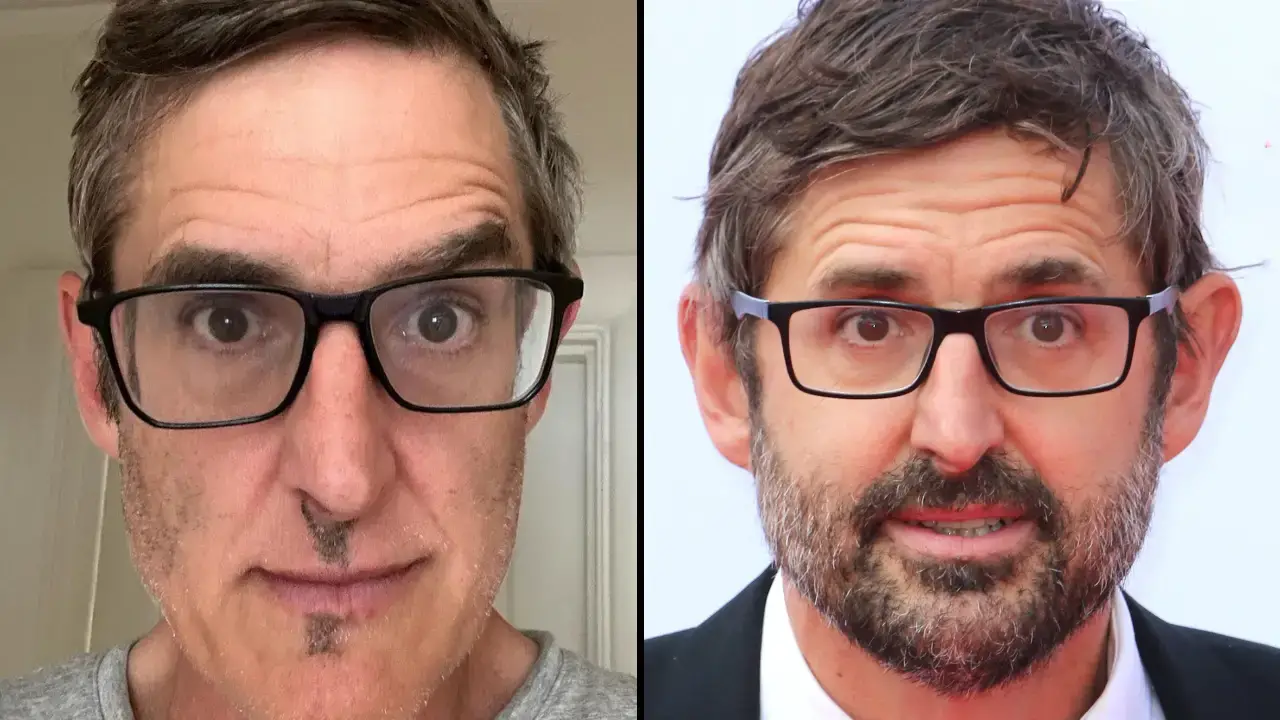 Louis Theroux has uploaded a photo of his beard, revealing that he has alopecia barbae.