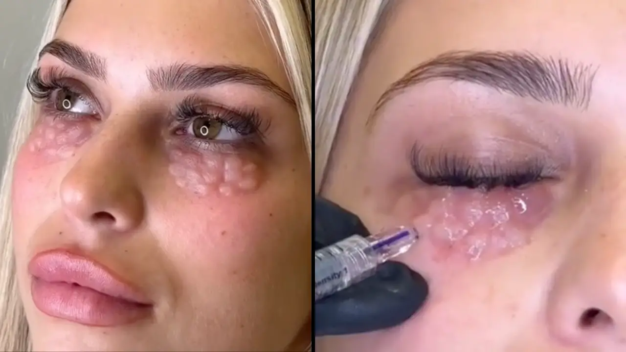 Doctors are warning against a dangerous trend called mesotherapy, as it can result in people looking like 'reptiles.'
