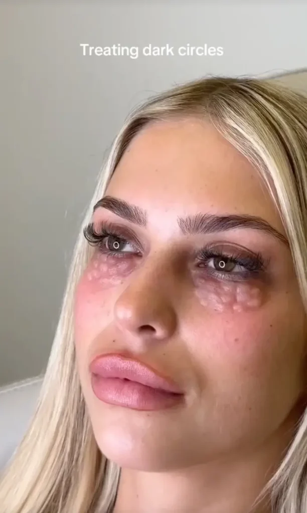 Mesotherapy