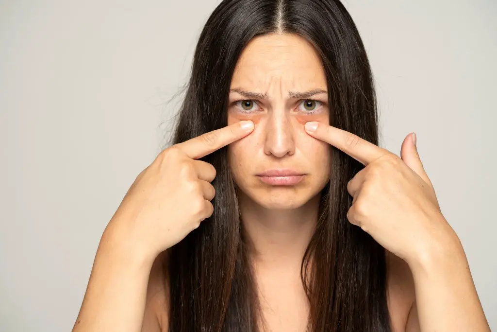 Under-eye bags