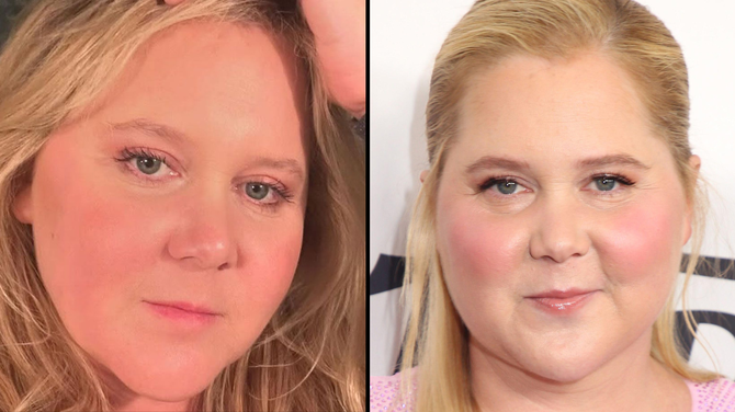 Amy Schumer has revealed that cruel 'moon face' remarks made on social media ultimately led to a shock health diagnosis.