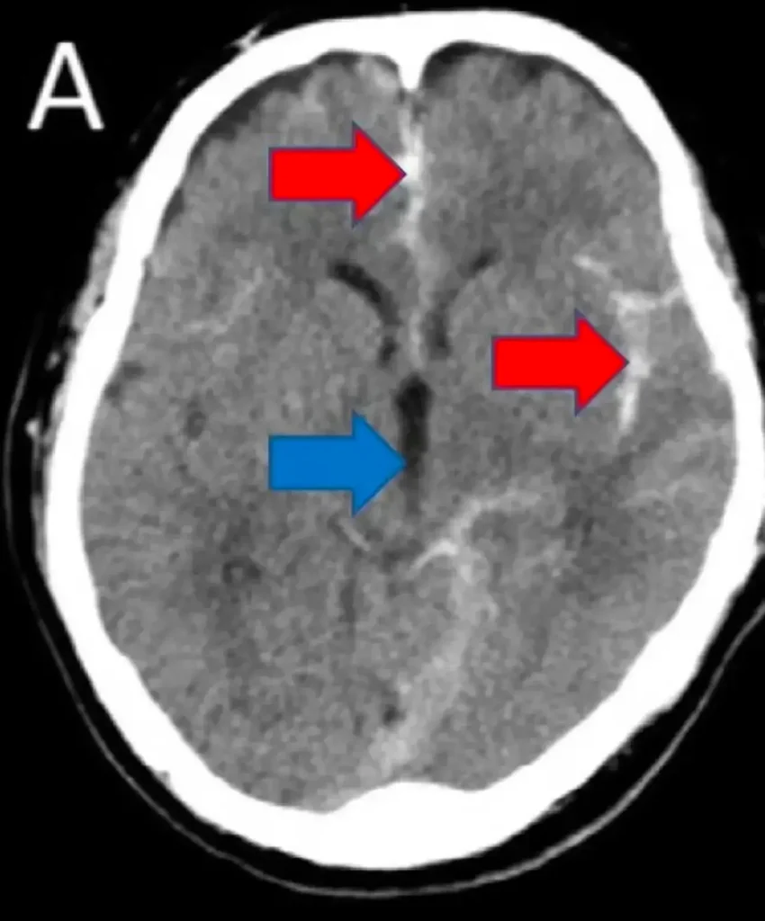CT scan of man who almost died pleasuring himself.