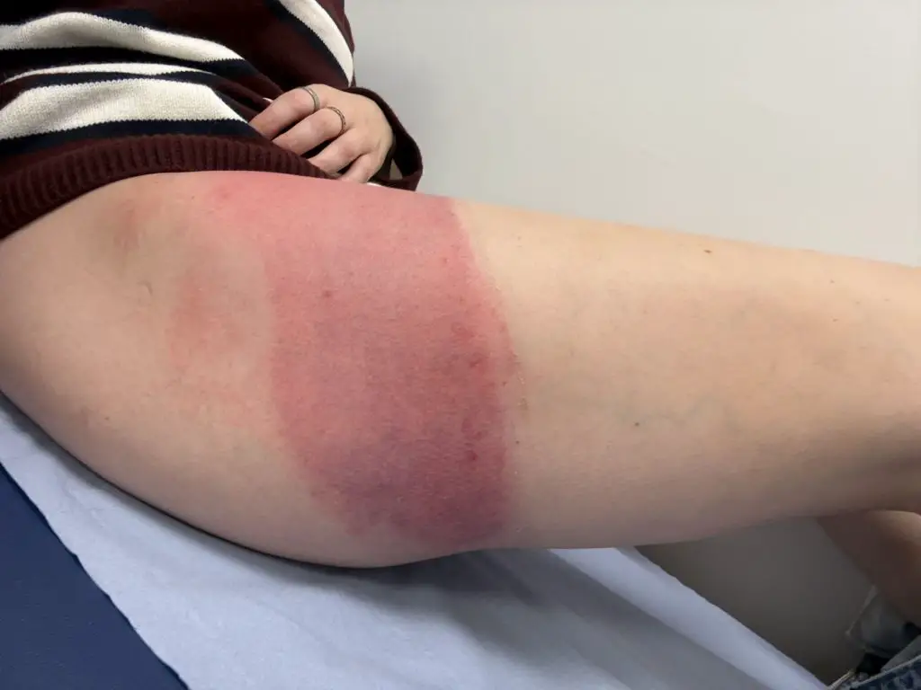 Annie Thomas' injury.