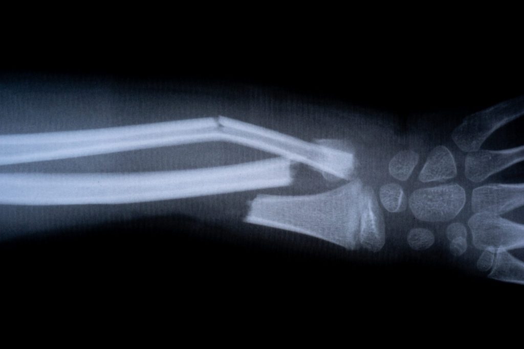 Broken arm X-ray.