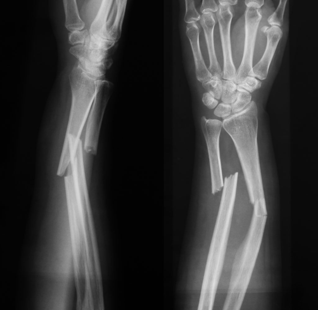 Broken bone