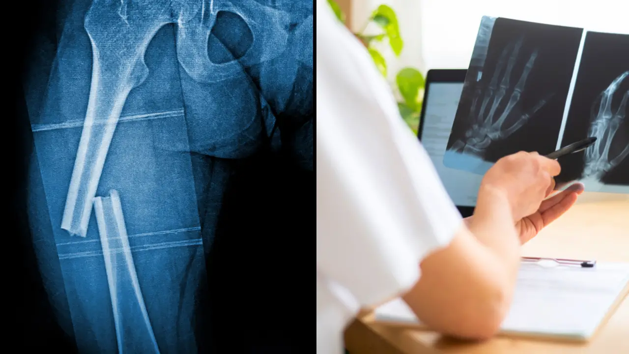 A doctor has spoken out on three bizarre theories about people who have never broken a bone.