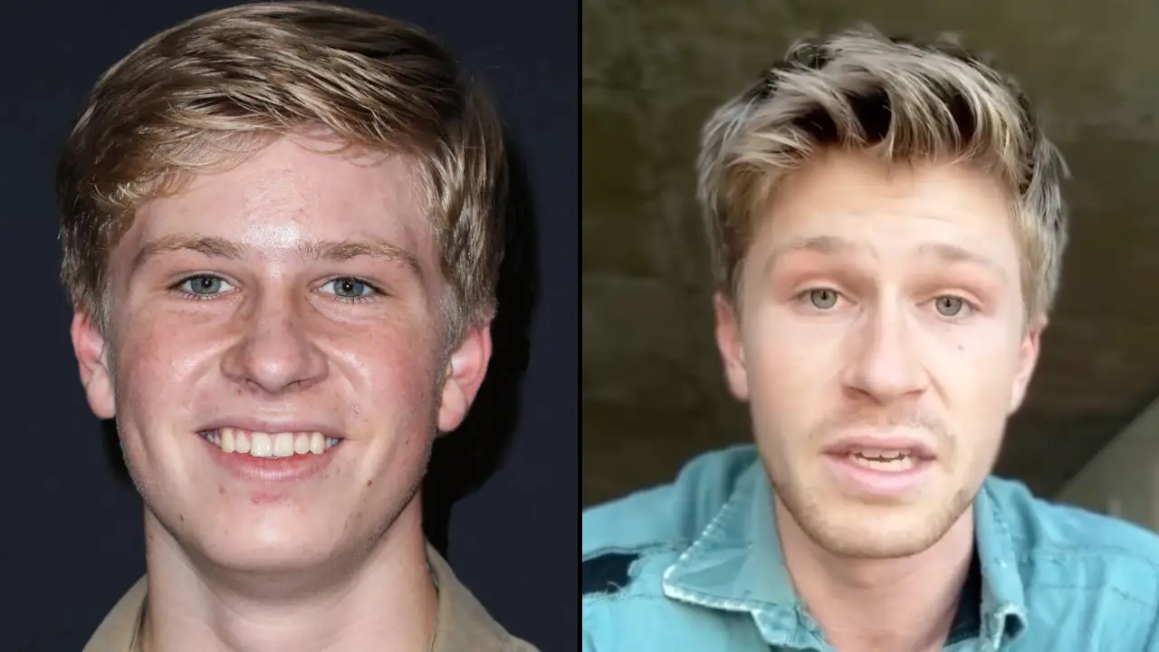 Fans are concerned after Robert Irwin issued a health update following his big win on Dancing with the Stars.