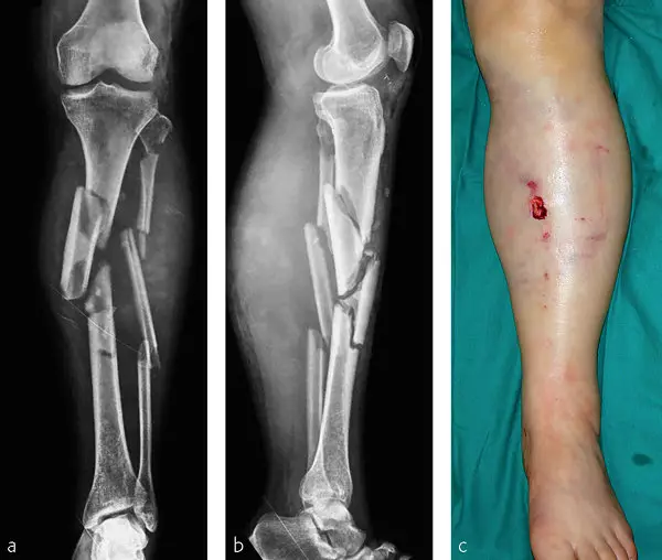 Tibia fracture