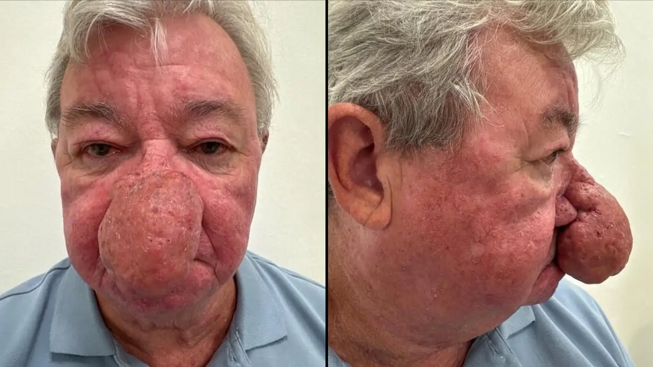 A man's nose growth has been described as one of the 'worst cases' a clinic has ever seen.