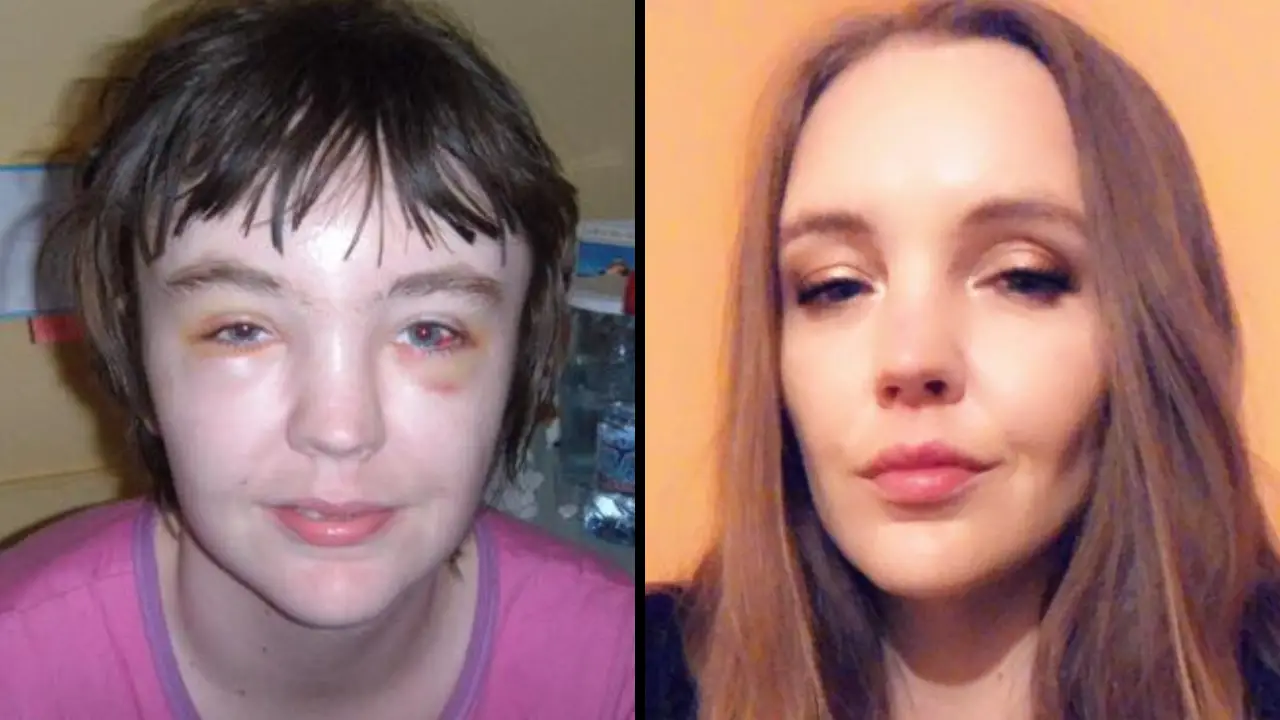 Woman Who Lost Her Entire Forehead Warns People Not To Put Feet On Dashboard